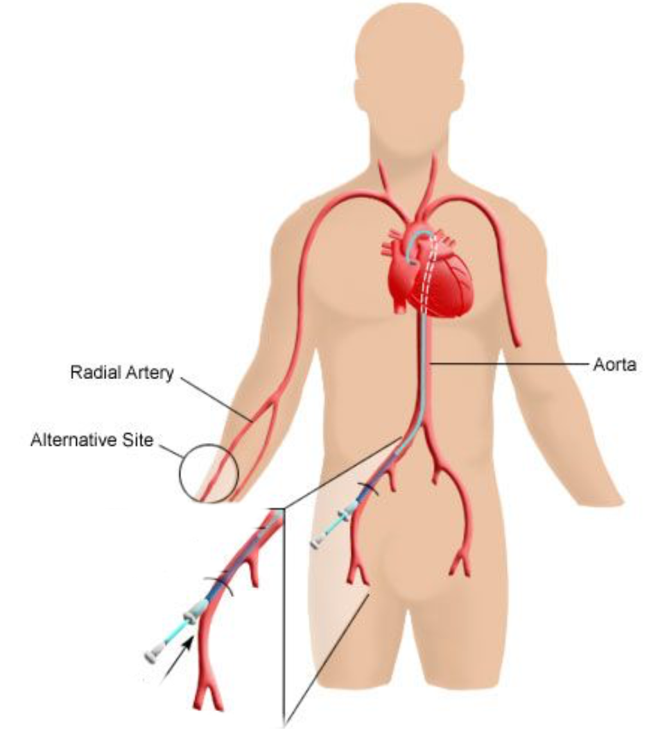 Операция через сосуды. Пункция лучевой артерии. Ангиография через бедренную артерию. Исследование сердца через бедренную артерию. Стентирование через бедренную артерию.